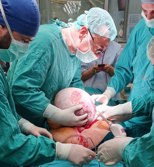 ДОКТОРИ ОВАКО НЕШТО НЕ ПАМТЕ: Шапчанка мислила да се угојила, хирурзи јој уклонили тумор од скоро 50 килограма